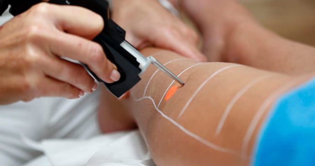 lazer yanıkları nasıl olur lazer yanıkları nasıl olur